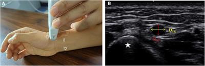 Is catheterization via distal transradial access feasible in children? From vessel diameter perspective